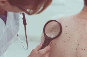 Melanoma: tassi di incidenza significativi nel Bellunese